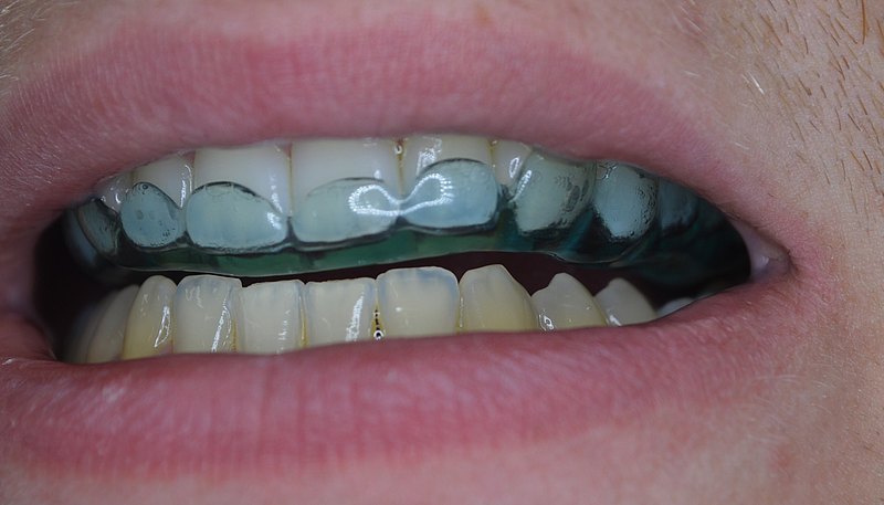 Was Sie während Ihrer Beratung zu transparenten Alignern erwartet